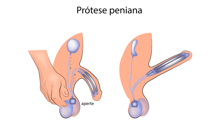 próteses penianas