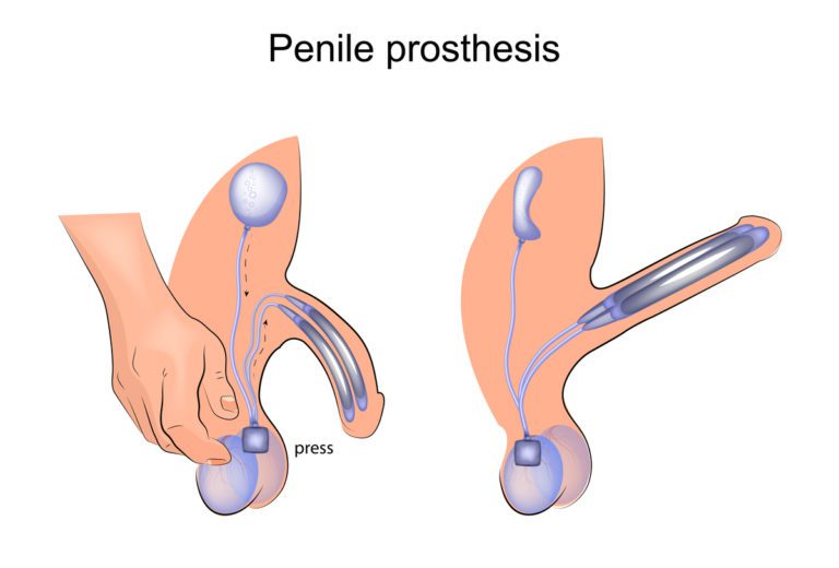 Indicações para próteses penianas