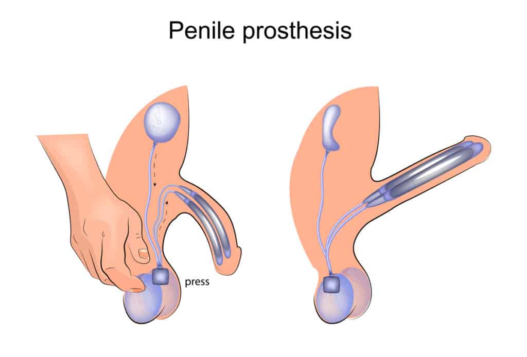 prótese peniana aumenta
