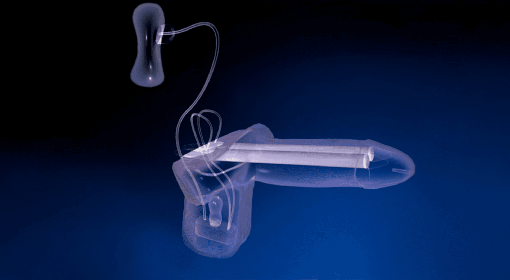 Imagem representativa do implante de prótese peniana