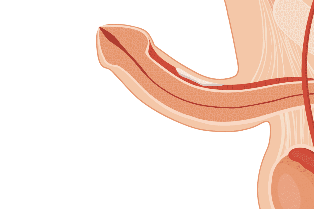 Desenho de pênis com curvatura acentuada devido à doença de peyronie, que tem tratamentos não cirúrgicos