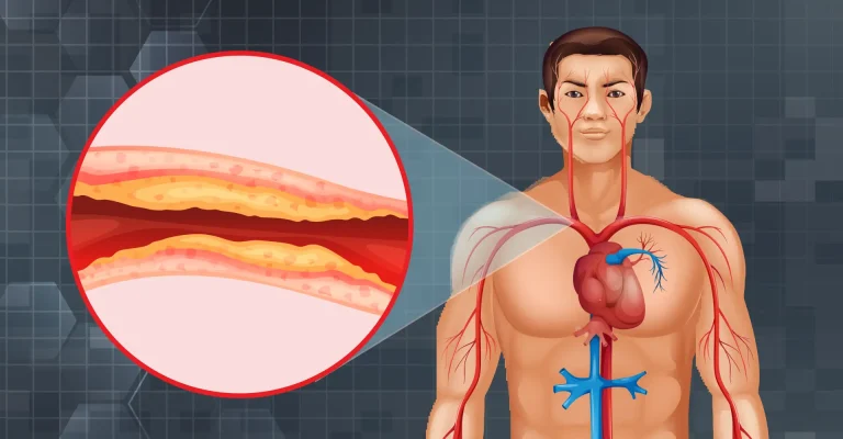 dislipidemia e disfunção erétil