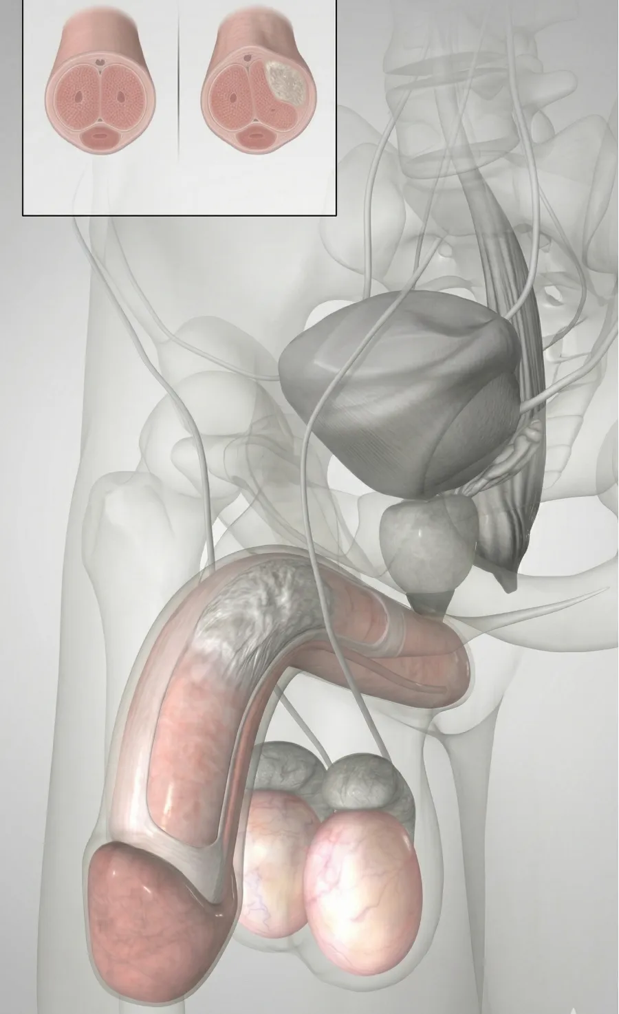 Ilustração da doença de Peyronie mostrando curvatura peniana causada por placa fibrosa