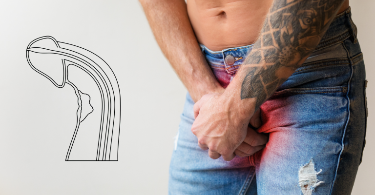 Dor causada pela doença de peyronie dura quanto tempo