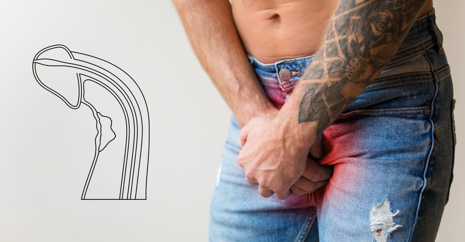 Dor causada pela doença de peyronie dura quanto tempo