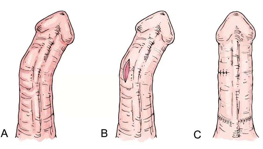 Ilustração da doença de Peyronie mostrando curvatura peniana causada por placa fibrosa