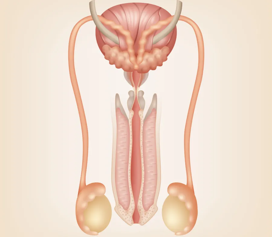 Reversão de vasectomia