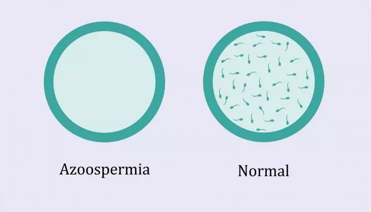 Azoospermia e normal